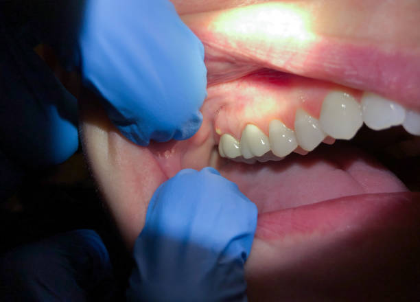 Best Emergency Dental Care for Broken or Chipped Teeth in Richfield Springs, NY